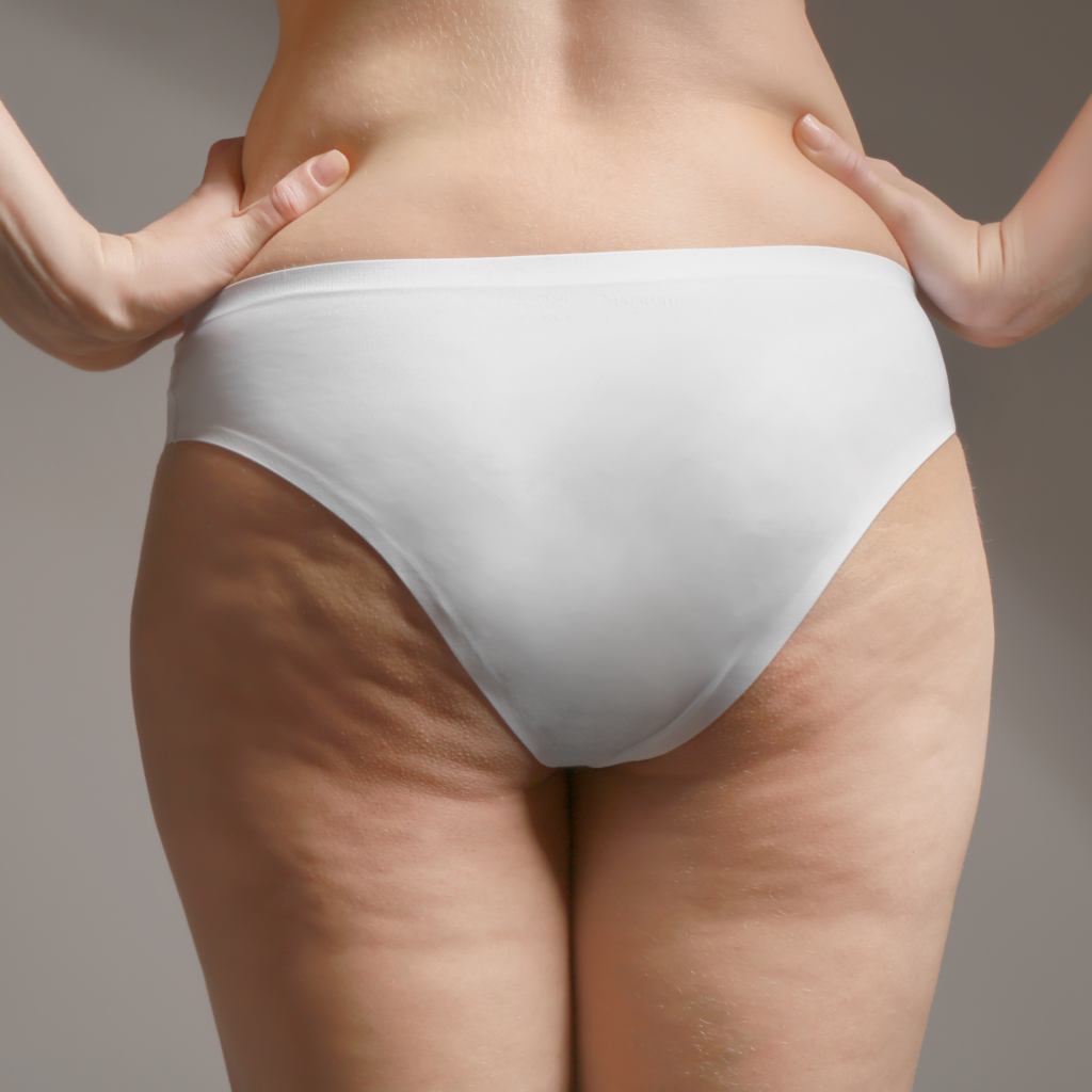 celulite-1024x1024 Diferença entre Lipedema e Linfedema