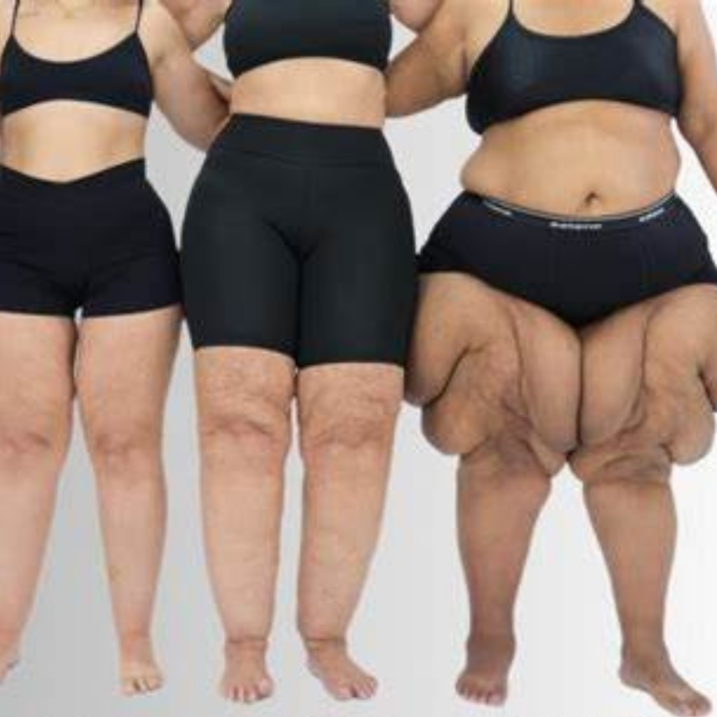 lipemema-1024x1024 Como Desinflamar o Lipedema?