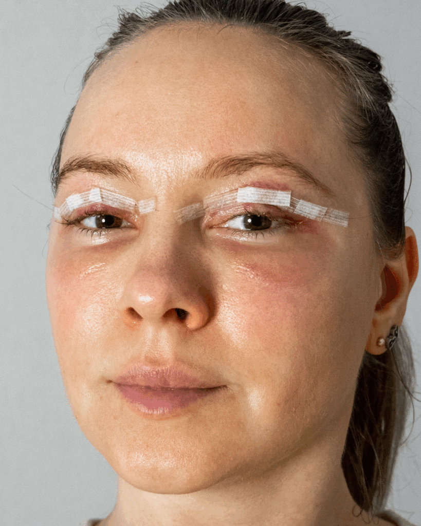 cirurgia-nas-palpebras-819x1024 O que é bom para desinchar após a blefaroplastia?