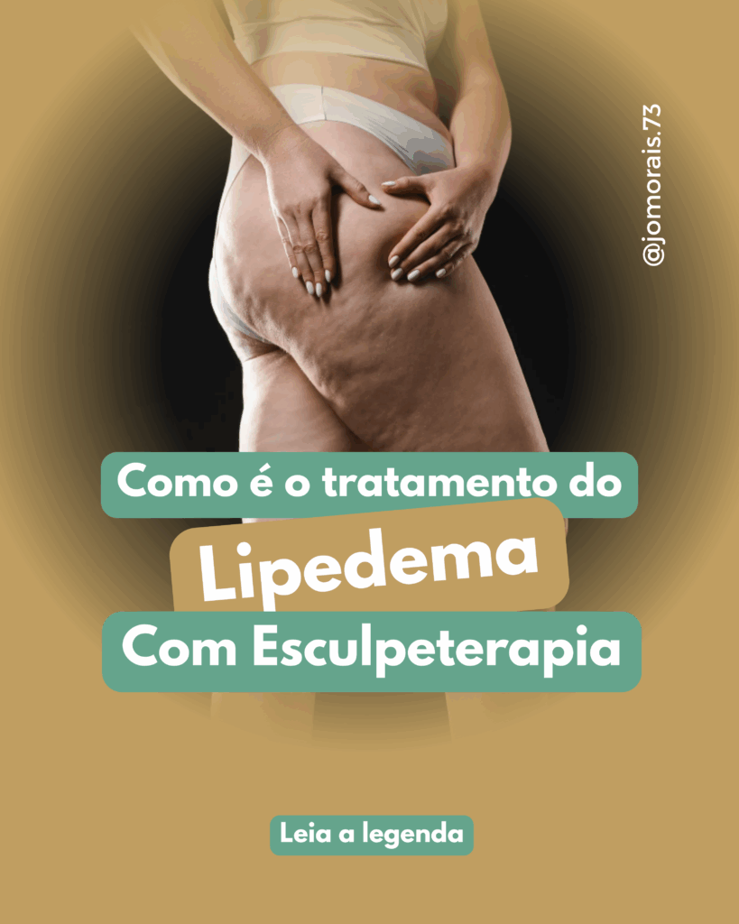 Lipedema-819x1024 Tratamento do Lipedema com a Esculpeterapia