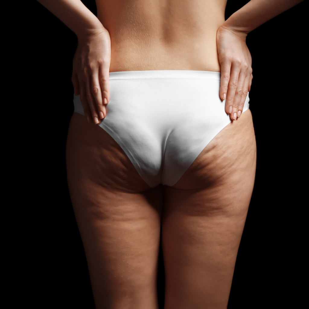 tratamento-de-lipedema-1024x1024 Como eliminar lipedema nas coxas?