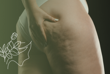 Causas do Lipedema