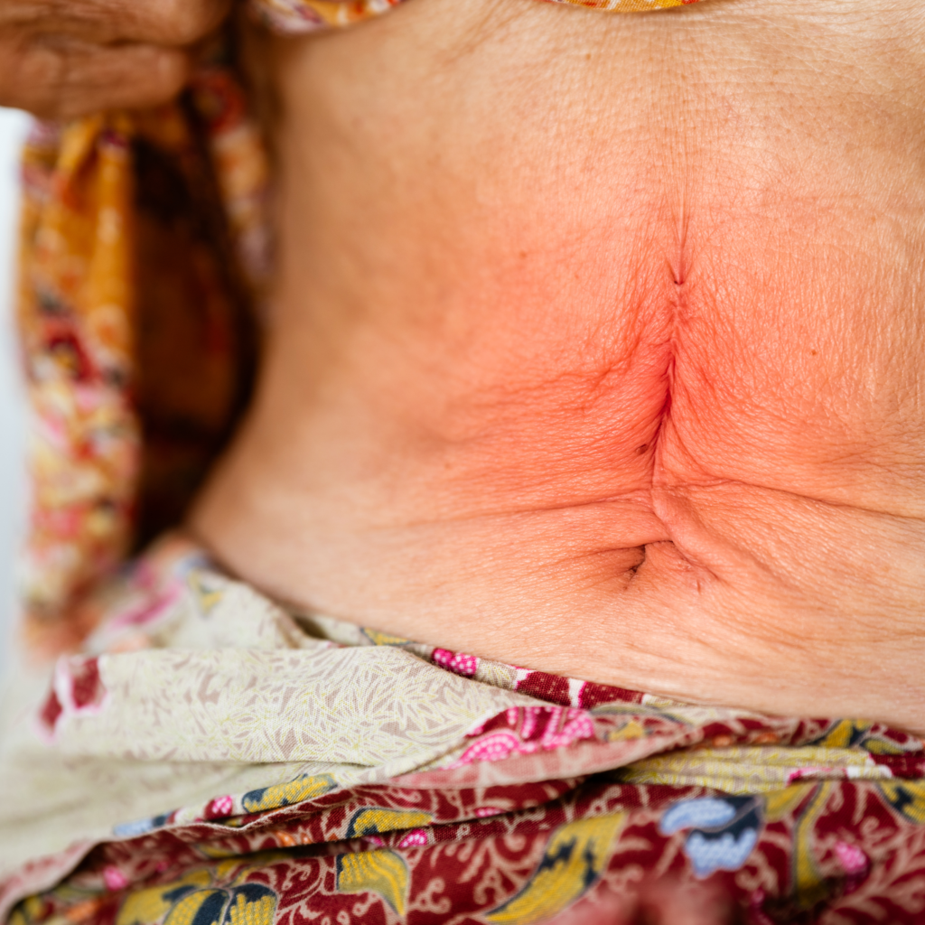 Recuperacao-Abdominoplastia-1-1024x1024 Como se recuperar mais rápido da abdominoplastia?