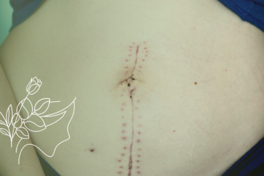 Como se recuperar mais rápido da abdominoplastia?