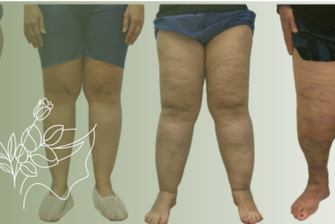 Qual o Melhor Tratamento para Flacidez Pós-Parto?