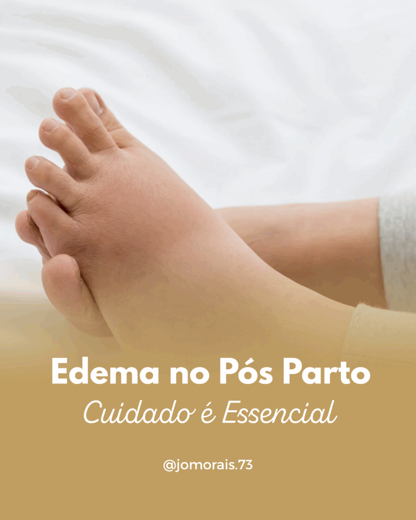 EDEMA-NO-POS-PARTO-819x1024 Recuperação no Pós-Parto com Carinho