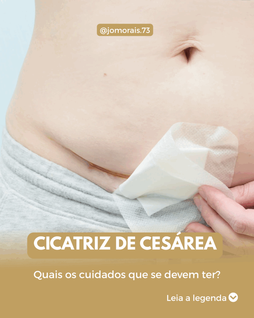 cicatriz-de-cesaria-1-819x1024 Cuidados com a Cicatriz da Cesárea
