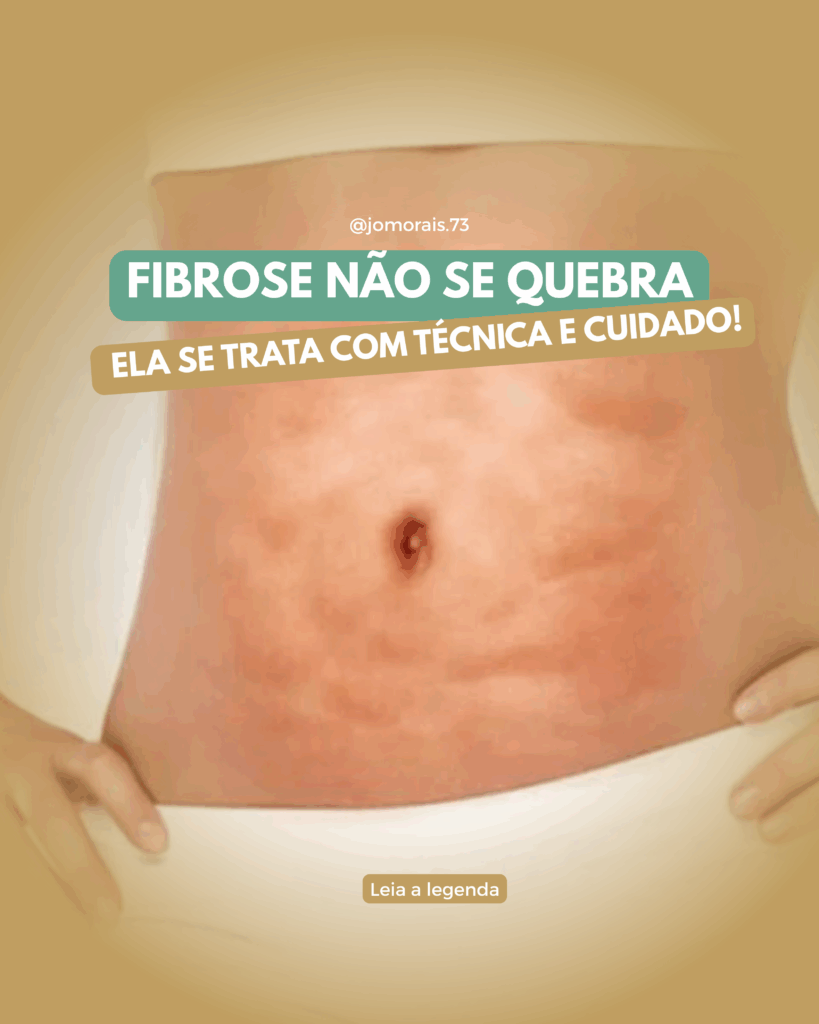 Fibrose-nao-se-quebra-819x1024 Como quebrar a fibrose