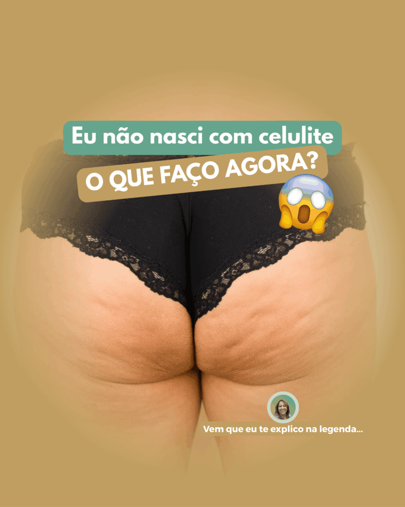 Eu-nao-nasci-com-celulite-819x1024 Por que a celulite aparece?