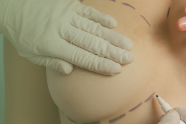 Drenagem Linfática Pós-Rinoplastia