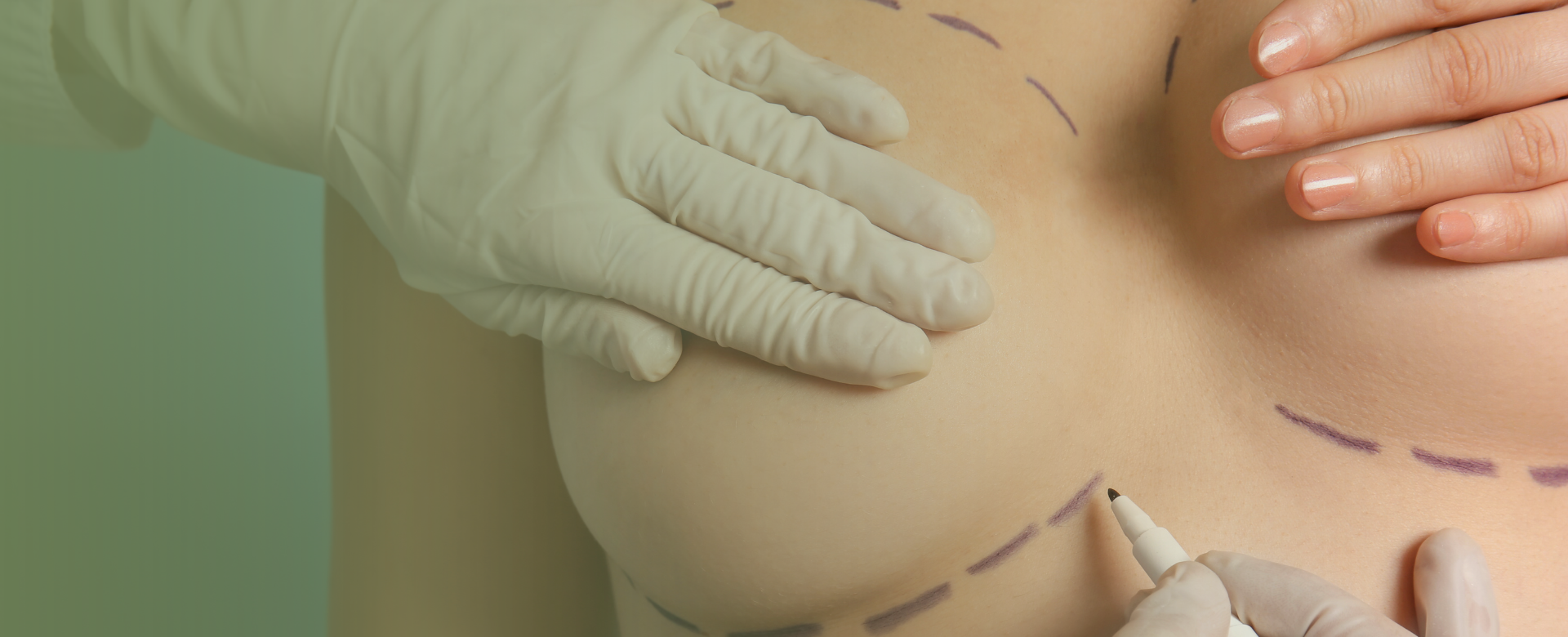 cirurgia-na-mama Como a drenagem linfática funciona?