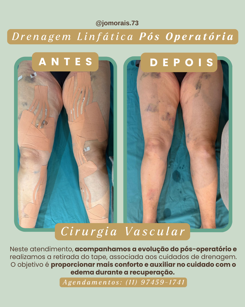 antes-3-819x1024 Drenagem Linfática Pós-Operatória de Cirurgia Vascular: Cuidados Importantes na Recuperação