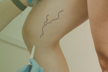 Drenagem Linfática Pós-Abdominoplastia