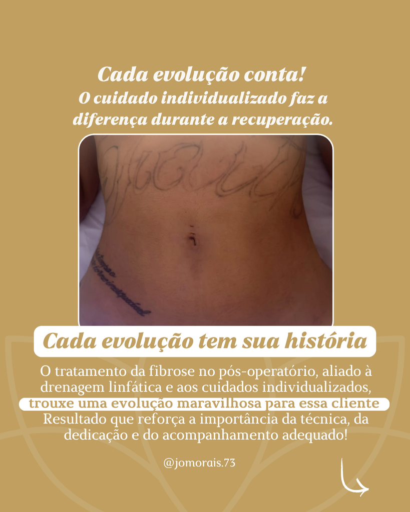 1-819x1024 Tratamento de Fibrose Após Cirurgia Plástica